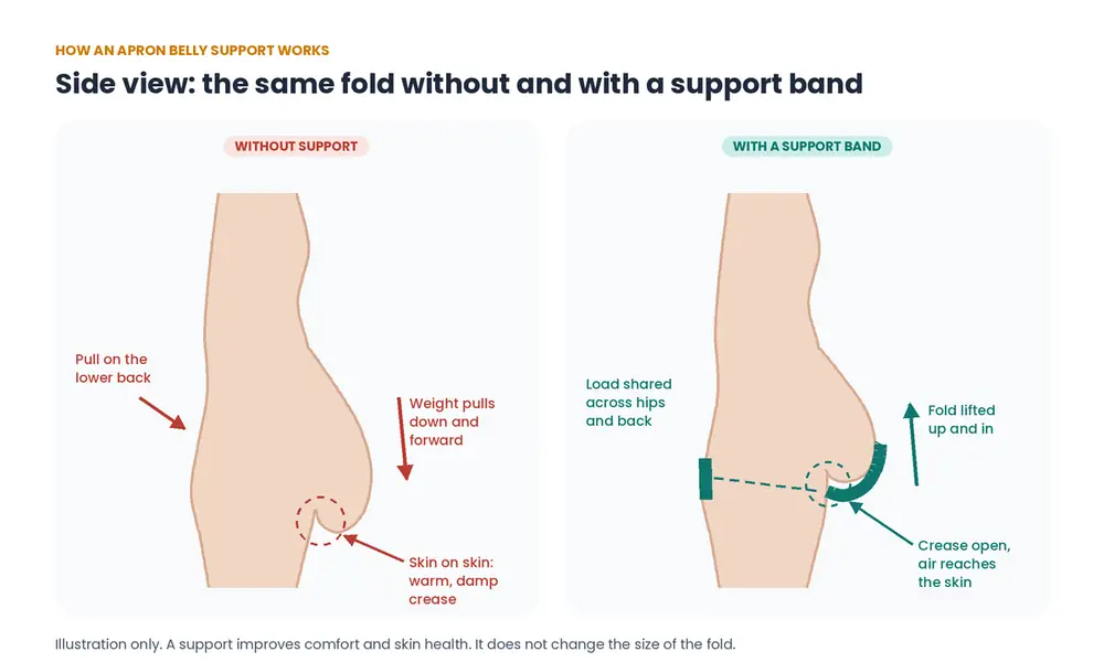 Side view diagram of an apron belly without and with a support band, showing the fold lifted and the crease opened