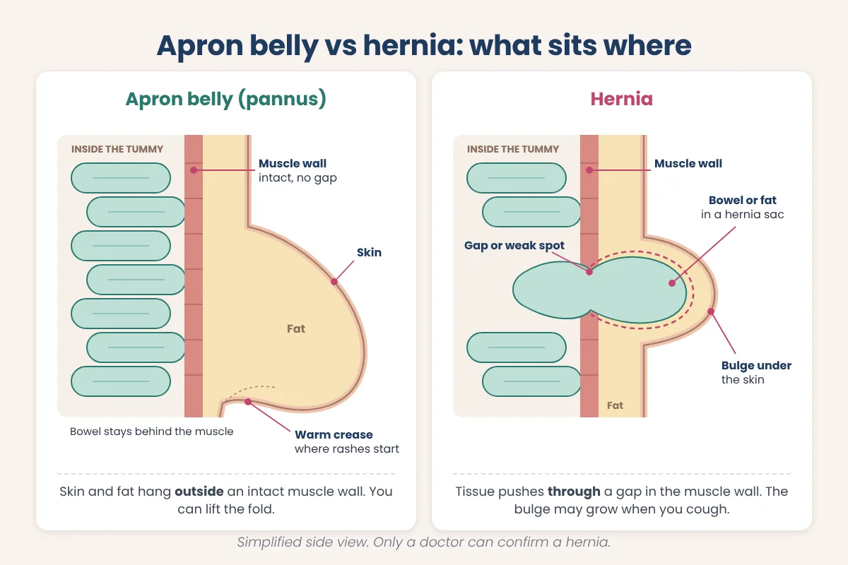 Cross-section diagram comparing an apron belly fold outside an intact muscle wall with a hernia pushing through a gap in the muscle