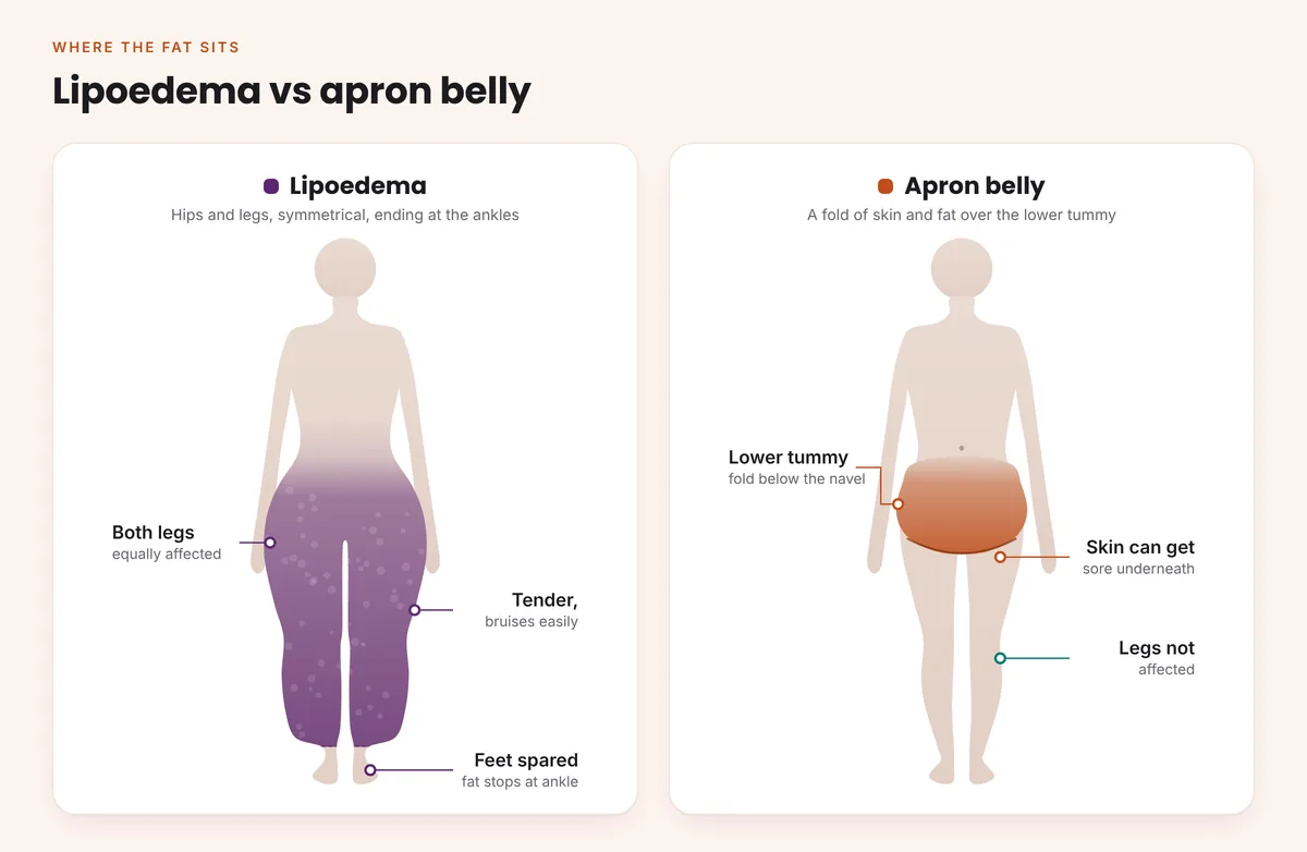 Diagram comparing lipoedema fat on both hips and legs with feet spared against an apron belly fold on the lower tummy