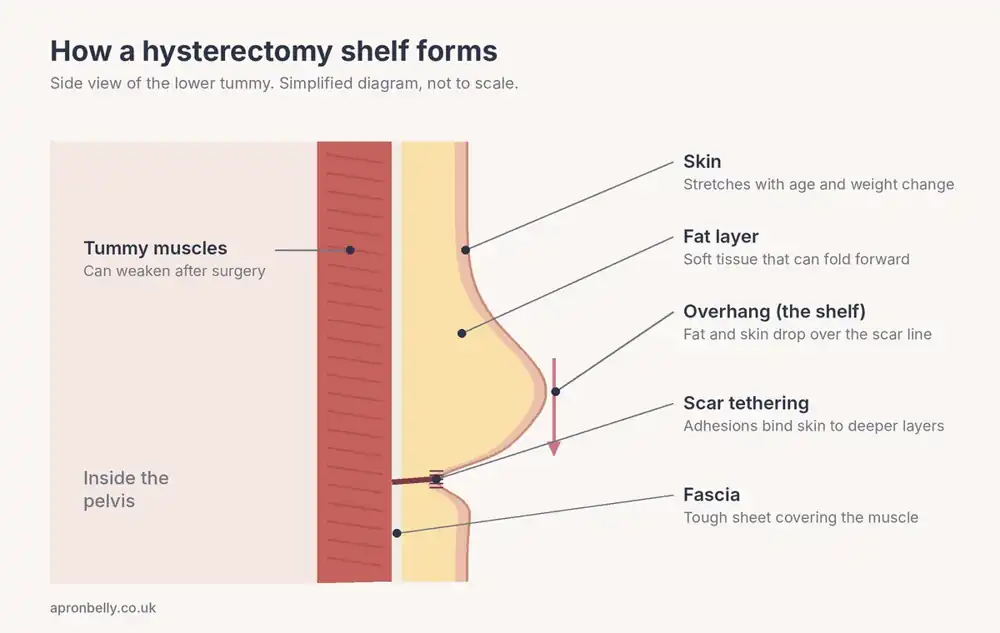 Diagram of a hysterectomy shelf showing skin, fat, scar tethering, fascia and tummy muscles