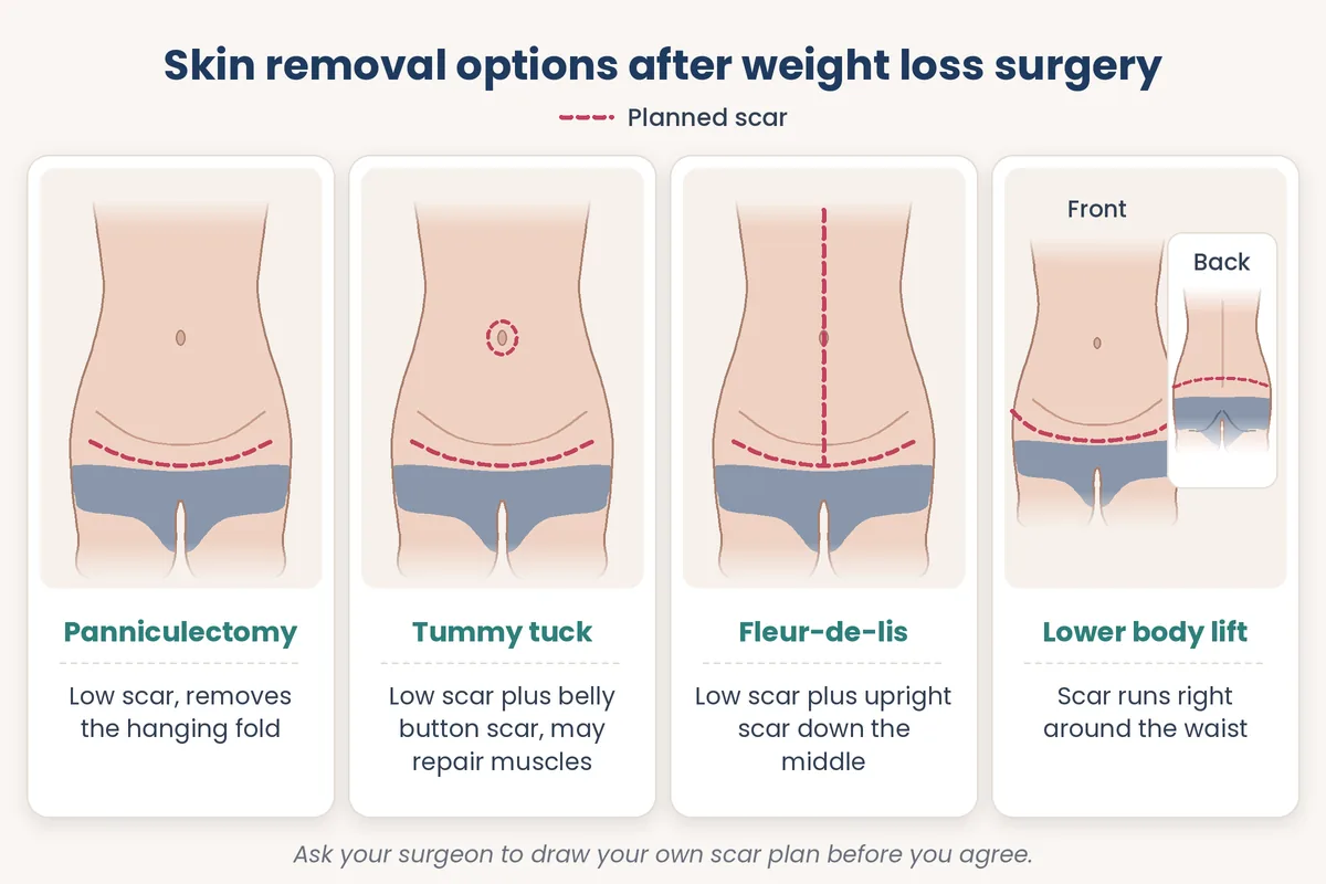 Labelled diagram comparing panniculectomy, tummy tuck, fleur-de-lis and lower body lift scars after bariatric weight loss
