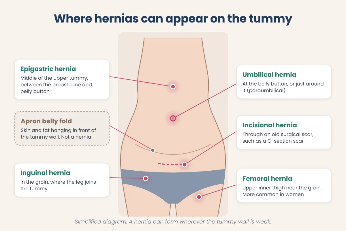 Labelled diagram of a female torso showing epigastric, umbilical, incisional, inguinal and femoral hernia sites next to an apron belly fold
